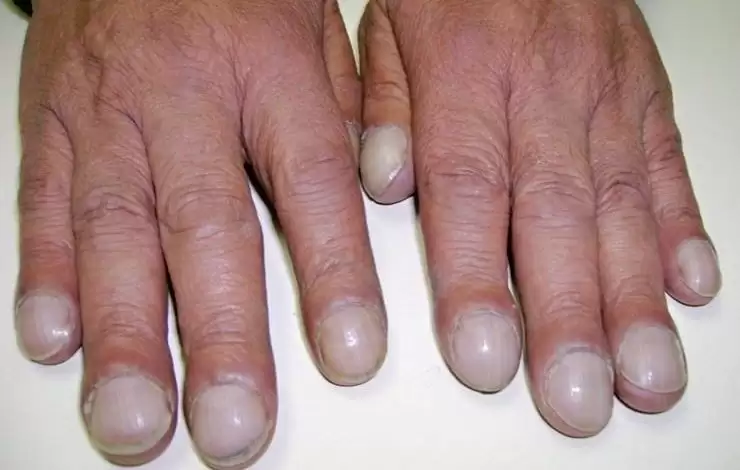 4 علامات تحذيرية في اليدين تشير إلى حالة صحية خطيرة في الكبد! تعرف عليها